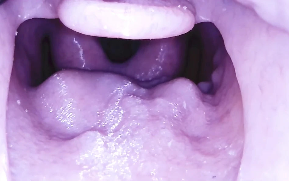 Picture of swollen glottic opening, Angio Edema insert Decent Simulator V2 Airway Manikin