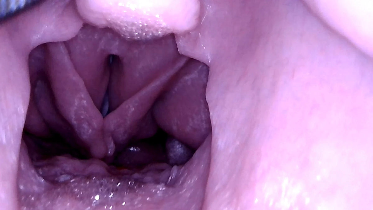 Laryngoscopic view of the upgraded Decent V2 standard airway
