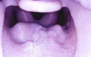 Picture of swollen glottic opening, Angio Edema insert Decent Simulator V2 Airway Manikin