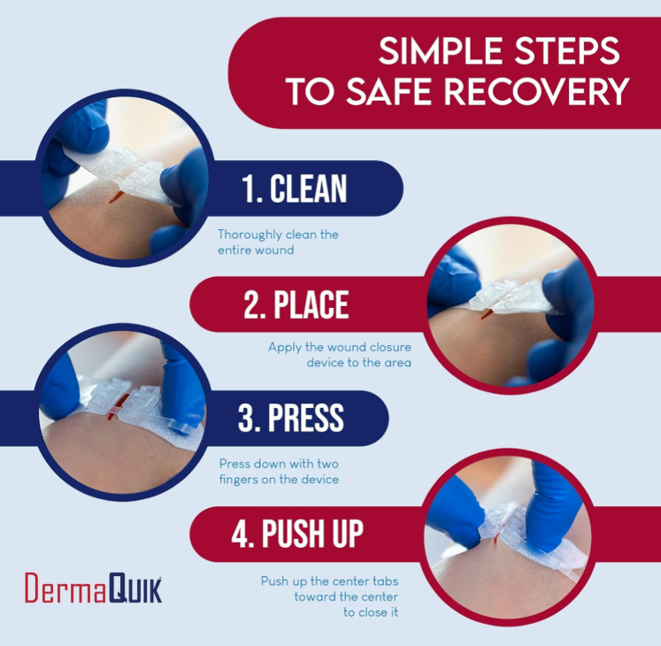 Steps to utilize the derma quick 62552 sport and extreme laceration repair kit.