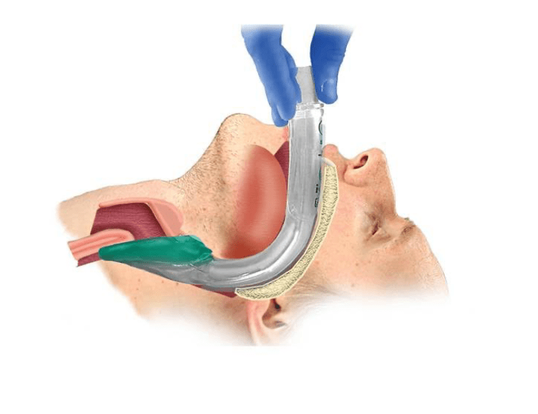 Diagram of I-gel positioned at the glottic opening occluding the esophagus at the upper esophageal sphincter. PN: 8703030, 8704030, 8705030.