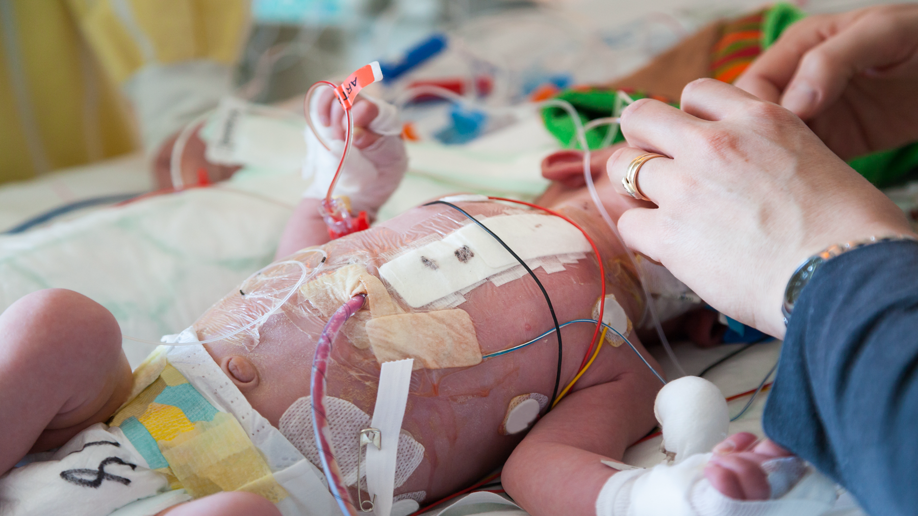 Neonate in intensive care being taken care of with pacific biomedical acute care products.