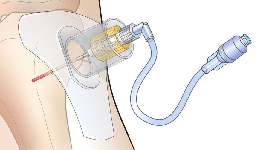 SAM IO Stabilizer, 5-Pack, Secures Needle Assembly