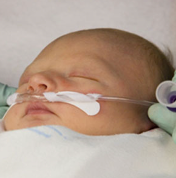 Mini-Whiskers™ Securement Device for Nasal Cannula