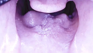 V2 Airway Trainer angioedema insert P0083 for the Decent Simulators C0010 difficult airway scenario rotation