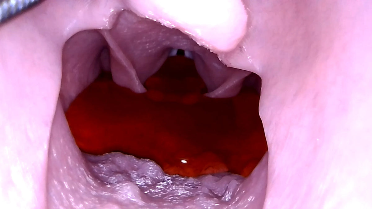 Simulated blood in the airway during SALAD suction-assisted laryngoscopy training on the Decent V2