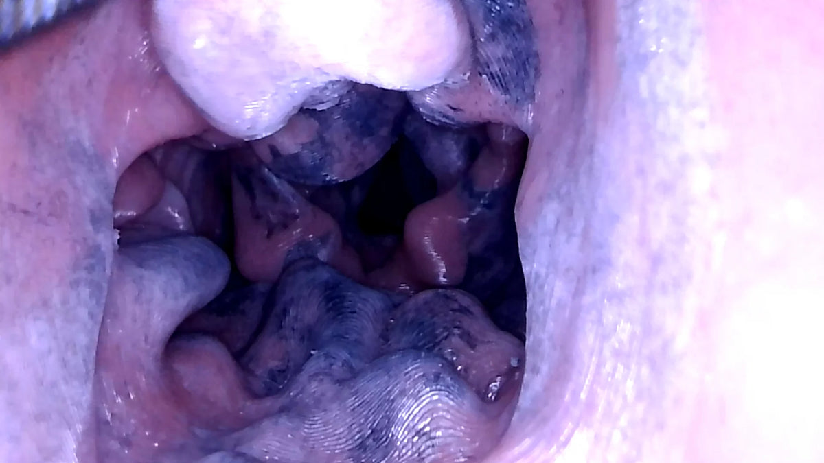 Simulated soot deposits around the glottis in the Decent V2 inhalation burn airway insert