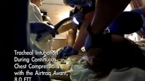 Intubating through chest compressions with Airtraq