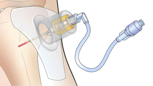 SAM IO Stabilizer - Pacific Biomedical